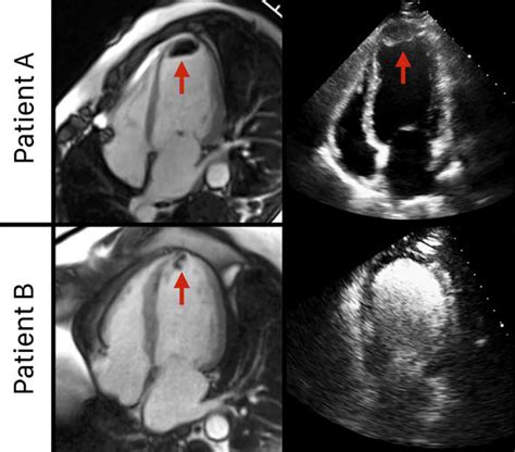 what is a lv monitor|Cardiac Imaging for Assessment of Left Ventricular Thrombus.